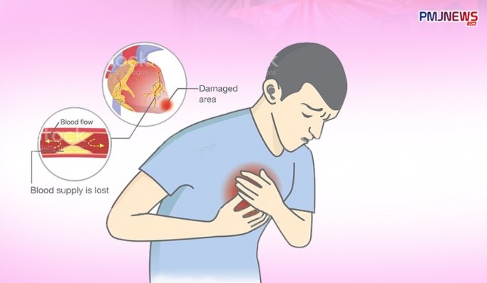 Serangan jantung yang sering disepelekan dapat merenggut nyawa. (Foto: PMJ News/Ilustrasi/Hadi)
