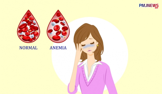 Penyakit anemia adalah masalah kesehatan yang terjadi saat jumlah sel darah merah dalam tubuh lebih rendah. (Foto: PMJ NEws/Ilustrasi/Hadi)