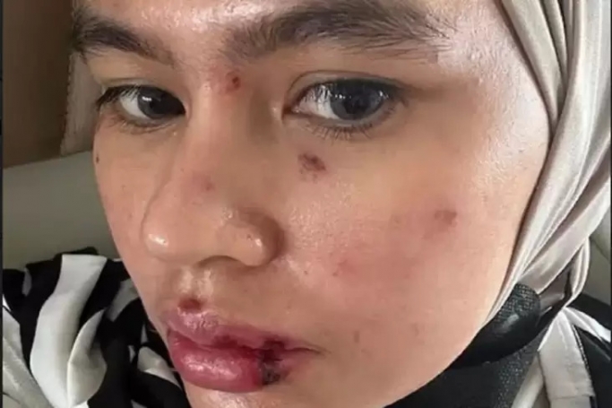Artis Kartika Putri bagikan foto wajah penuh lebam. (Foto: PMJ/Instagram).